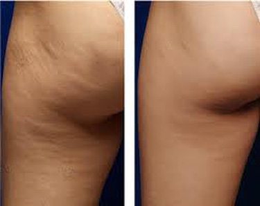 cryotherapy cellulite improvement