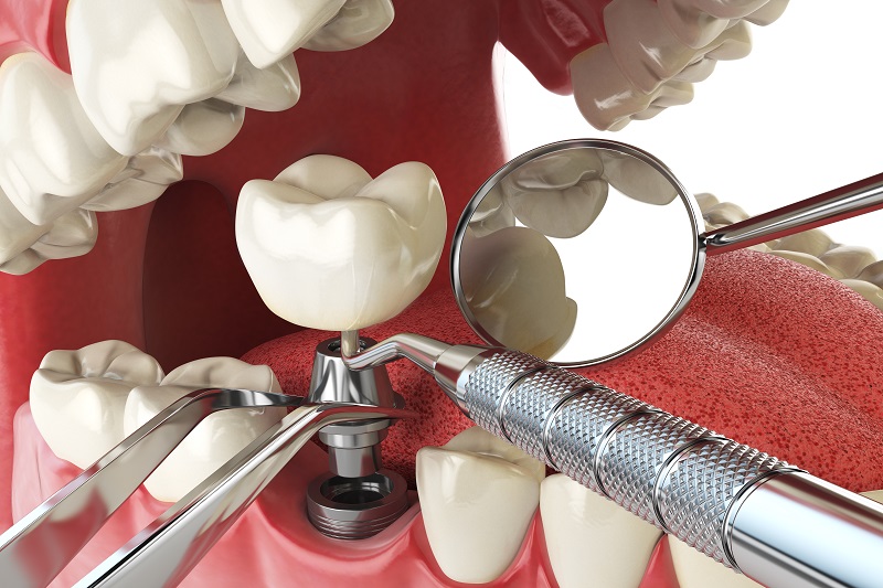 Key reasons to go for Implant Retained Dentures