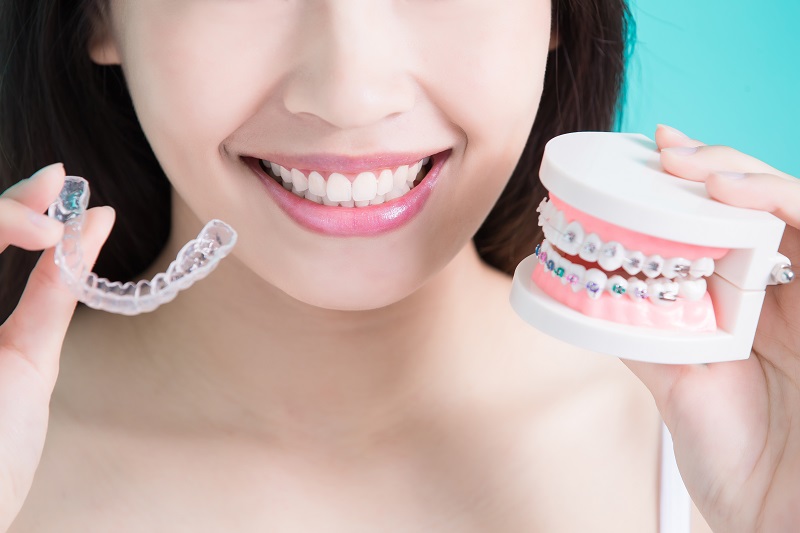 Points to Know Before Getting Clear Braces