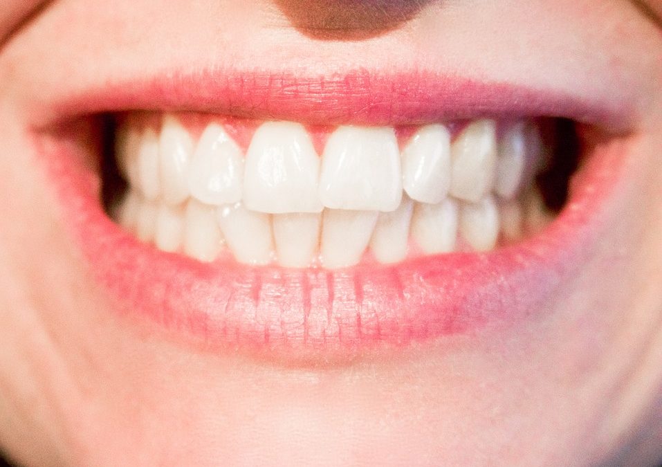 7 Signs You May Need Braces